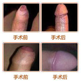 襄阳五医院割包皮